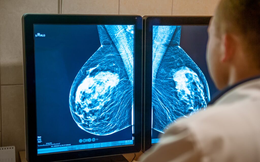 Mamografía digital analizada por un especialista como parte del proceso de detección temprana del cáncer de mama con apoyode la IA